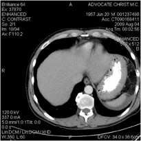 CT Scan